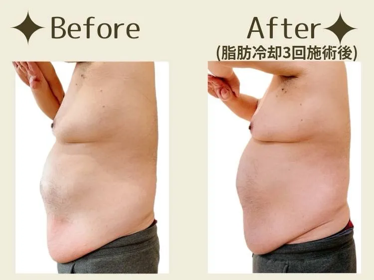 【脂肪冷却】