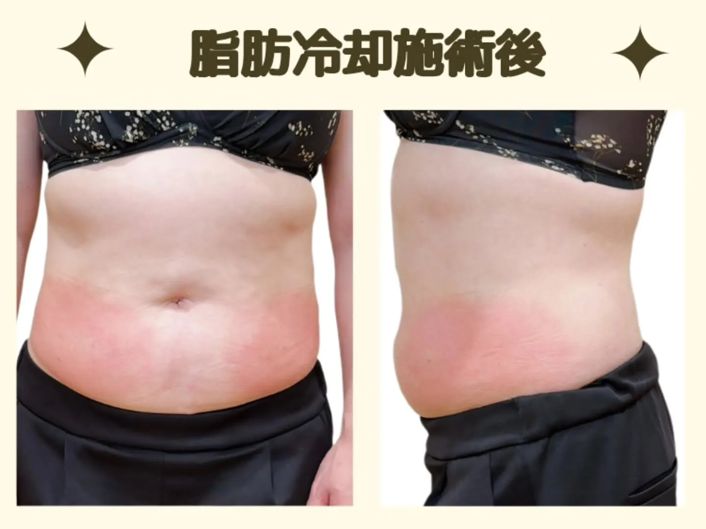 【脂肪冷却は痛い?】